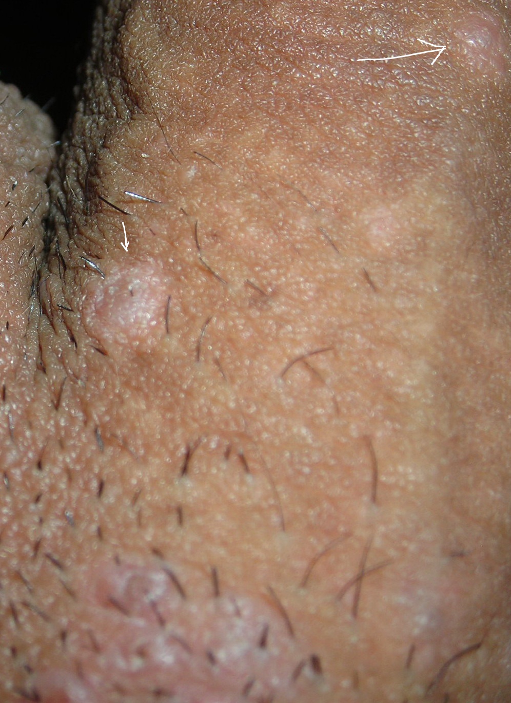 Skin Tags On Penis Shaft 19